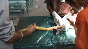 Raipur: Snake, beaten with sticks, saved after 45-minute operation. Now on 'bed rest'