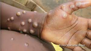 Monkeypox spreads to more countries, cases now reported in Israel, Switzerland and Austria